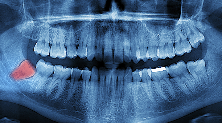 What do you know really know about your wisdom teeth?