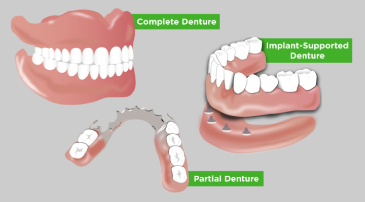 Restorative Care vs Dentures | Impact of Dentures on Health - Delta ...