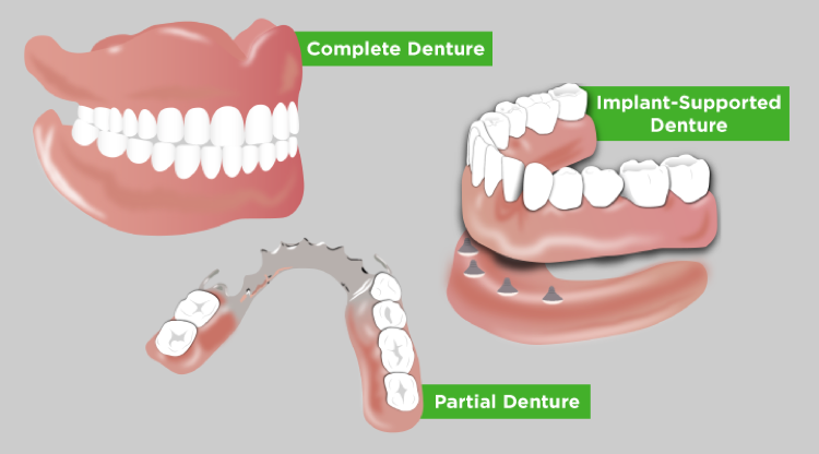 Three diagrams show how complete, partial, and implant-supported dentures operate in the mouth