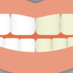 Cosmetic dental procedures, like cosmetic make-up, exist to change the way the mouth looks. Learn more about what classifies a dental procedure as cosmetic.