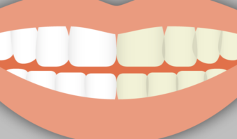Cosmetic dental procedures, like cosmetic make-up, exist to change the way the mouth looks. Learn more about what classifies a dental procedure as cosmetic.