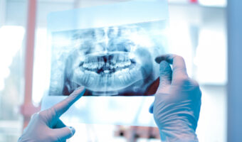What are wisdom teeth and why do we have them?