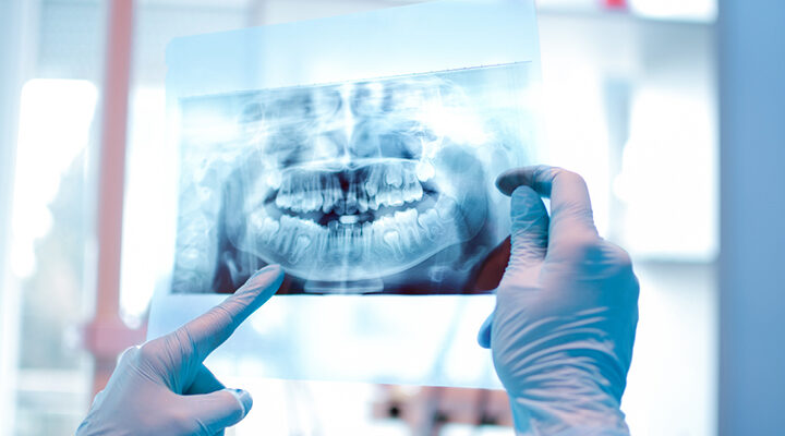 Does Everyone Have Wisdom Teeth? + All Your Questions Answered