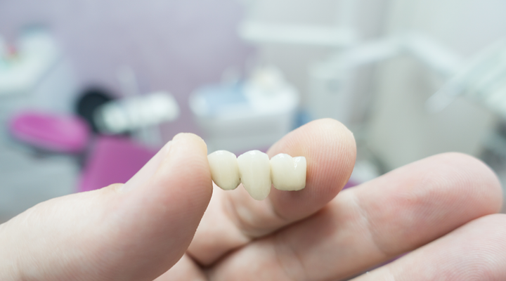 What is a dental bridge? What is a dental bridge procedure? What types of dental bridges are there? Get answers to these and many more questions in this informational dental bridge article.
