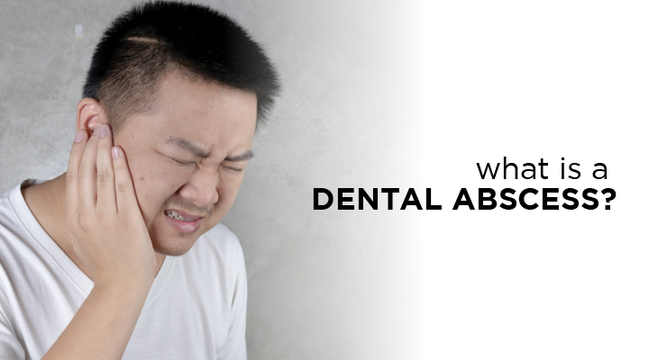 Oral health basics: What is a dental abscess